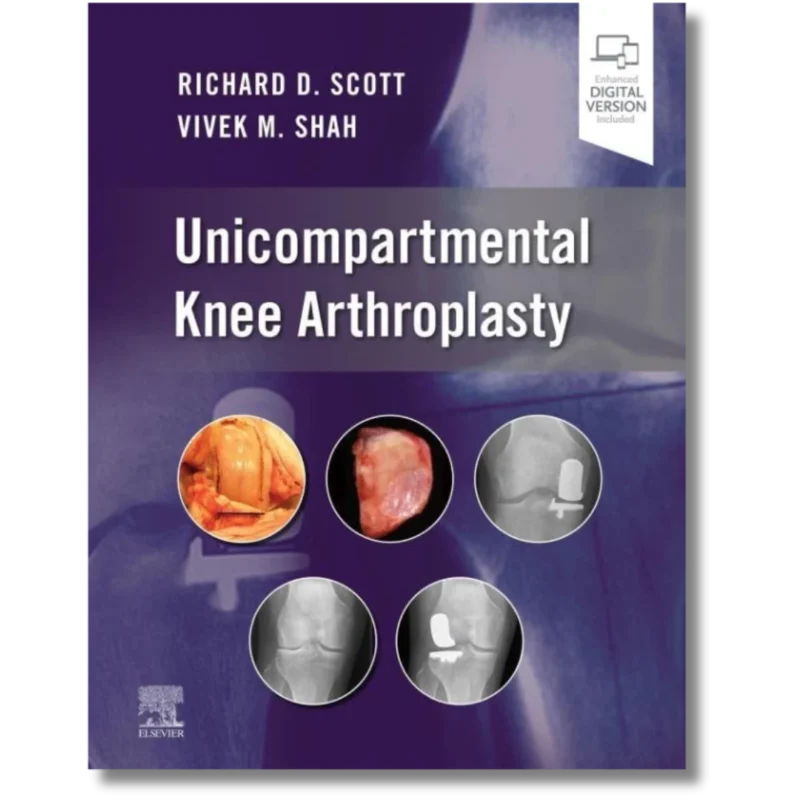 Unicompartmental Knee Arthroplasty